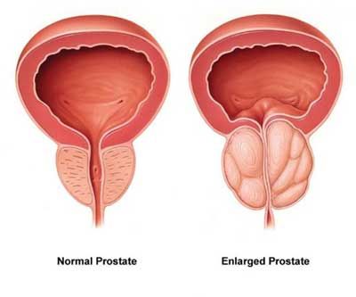 Prostate cancer treatment
