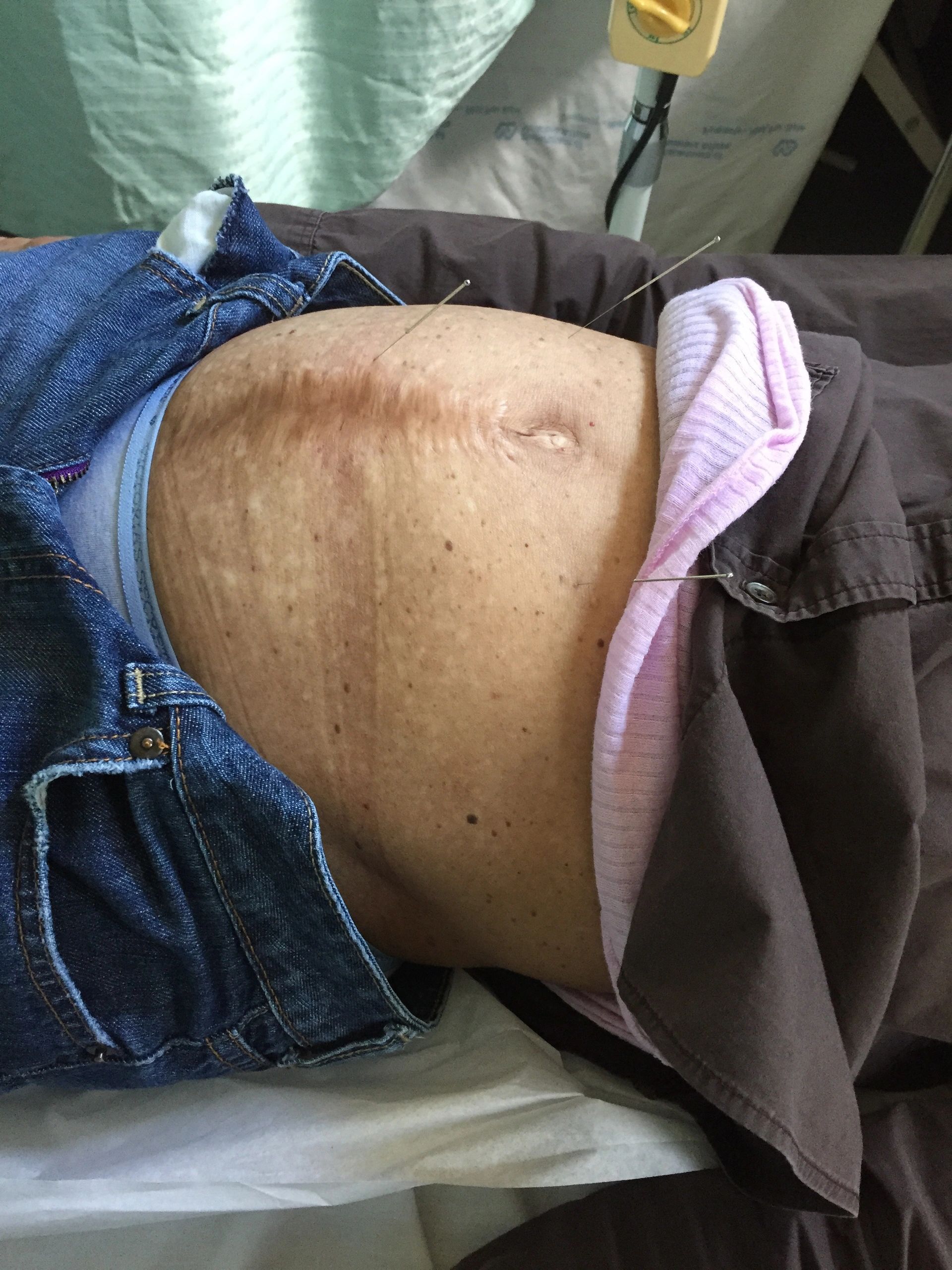 Fibroid and cyst treatment results