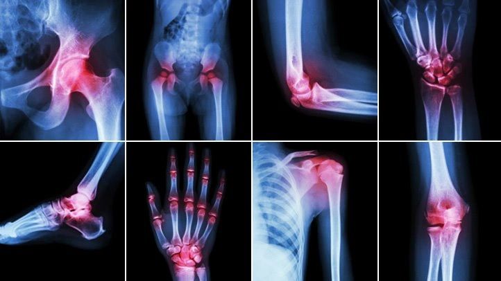 Acupuncture for arthritis pain