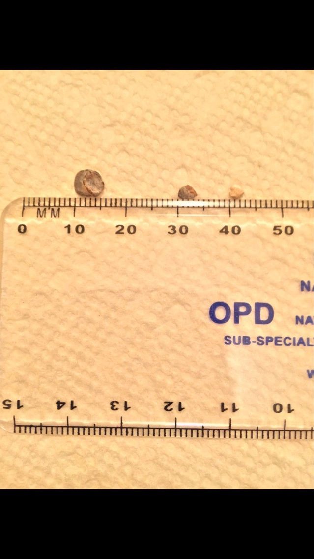 Kidney stone dissolved