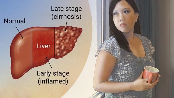 Hepatitis B treatment