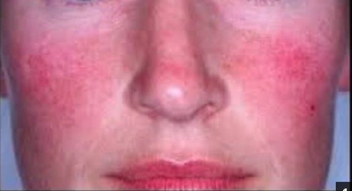 Rosacea treatment