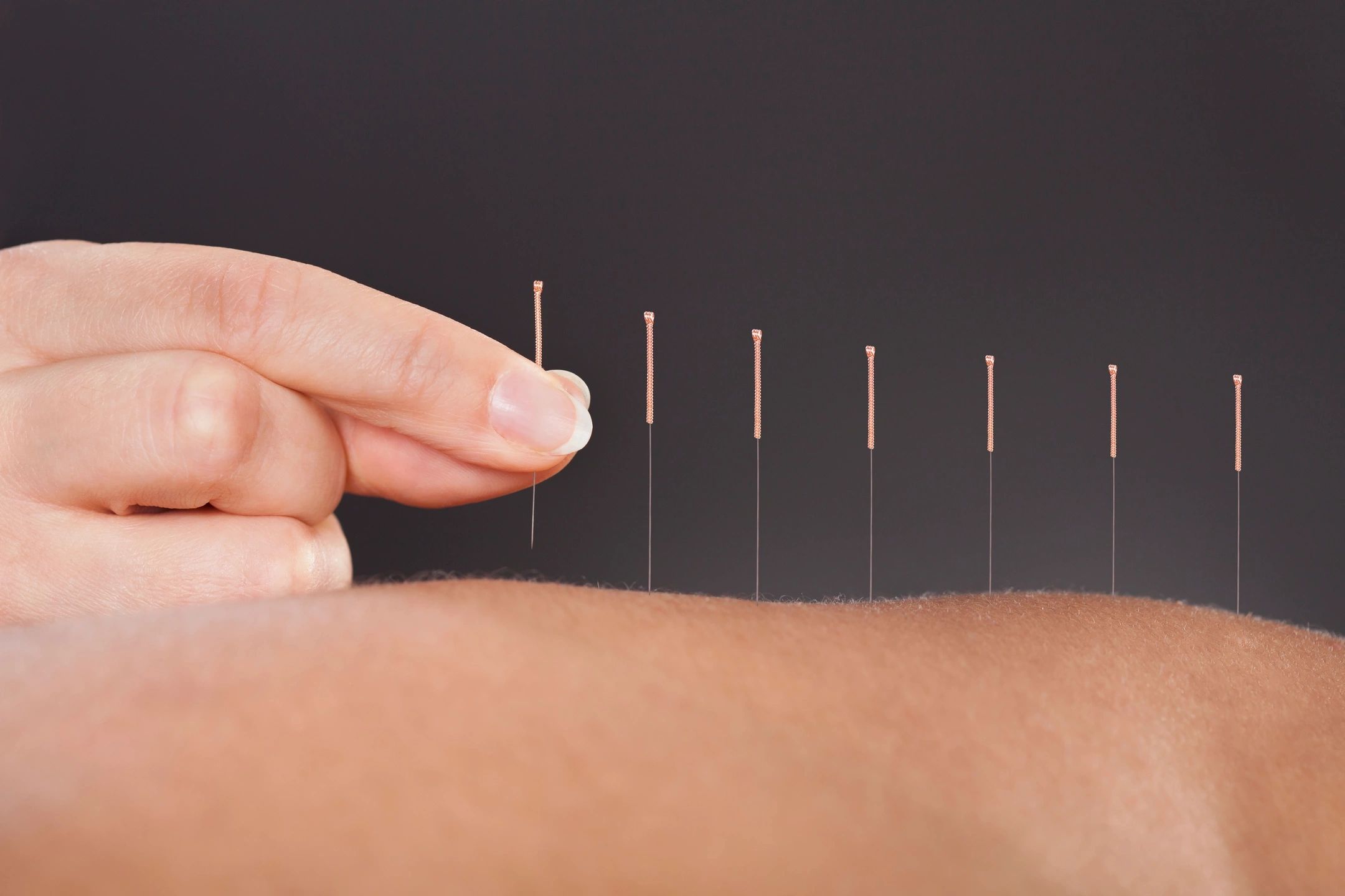 Acupuncture for back and joint pain