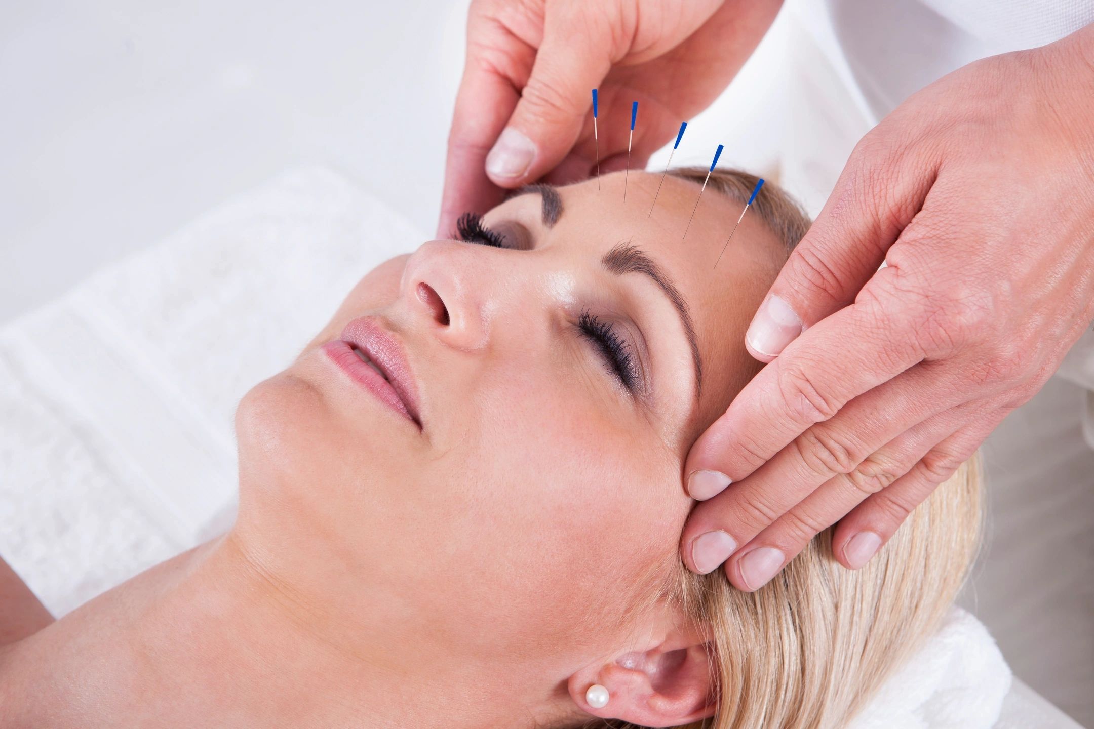 Acupuncture for UTI